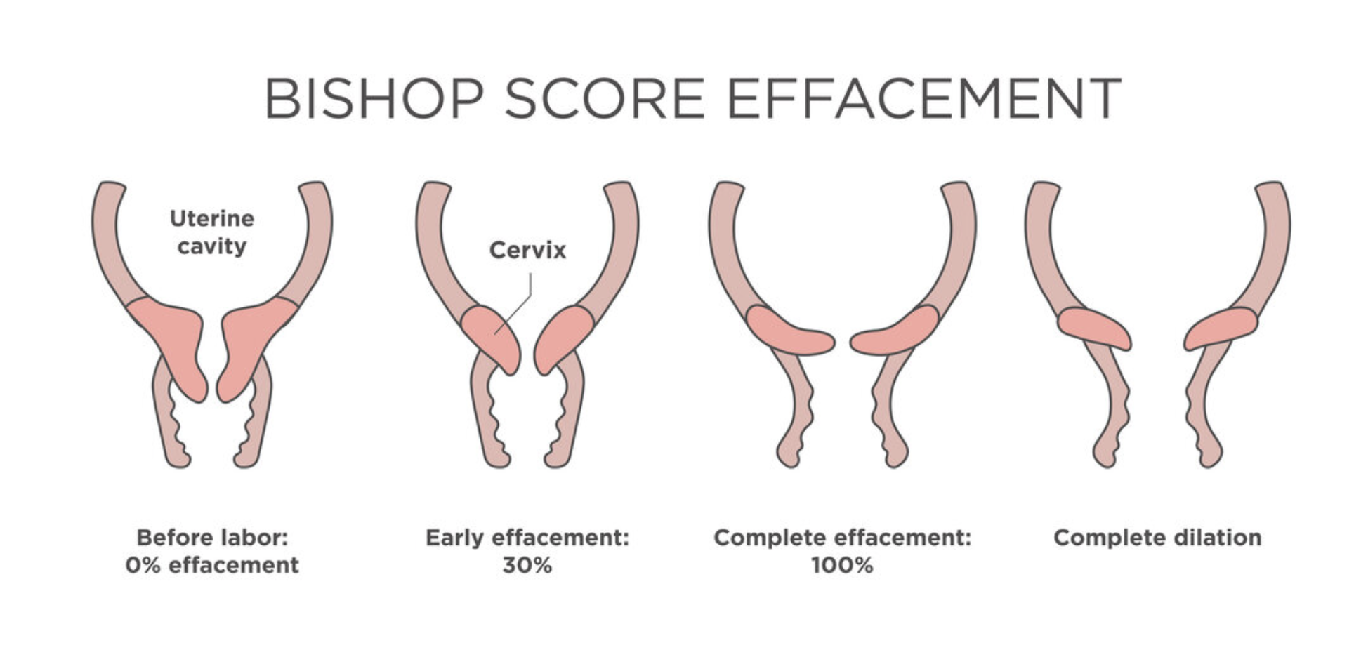 Induction of Labor Indications Methods Contraindications Complications