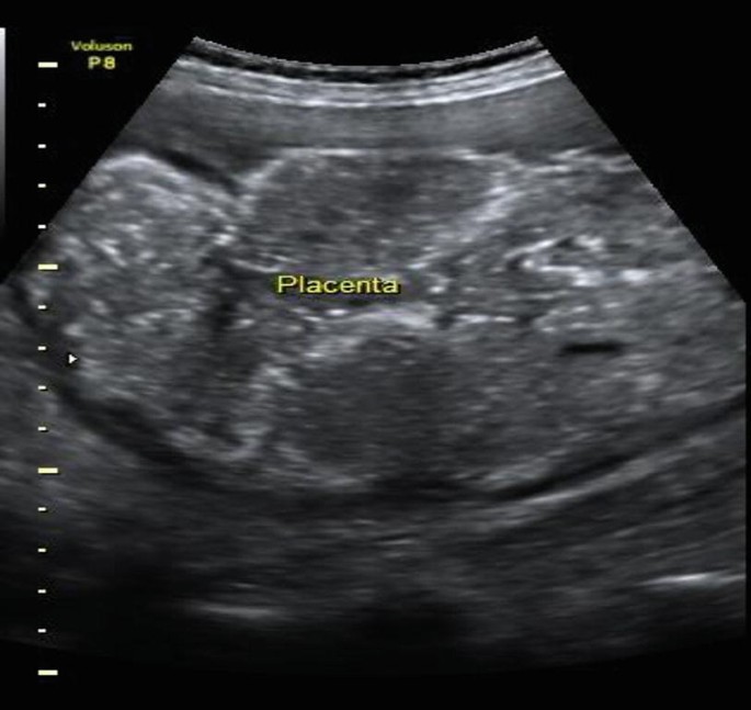 Post Term Pregnancy and Fetal Macrosomia Causes Risks Diagnosis and Management